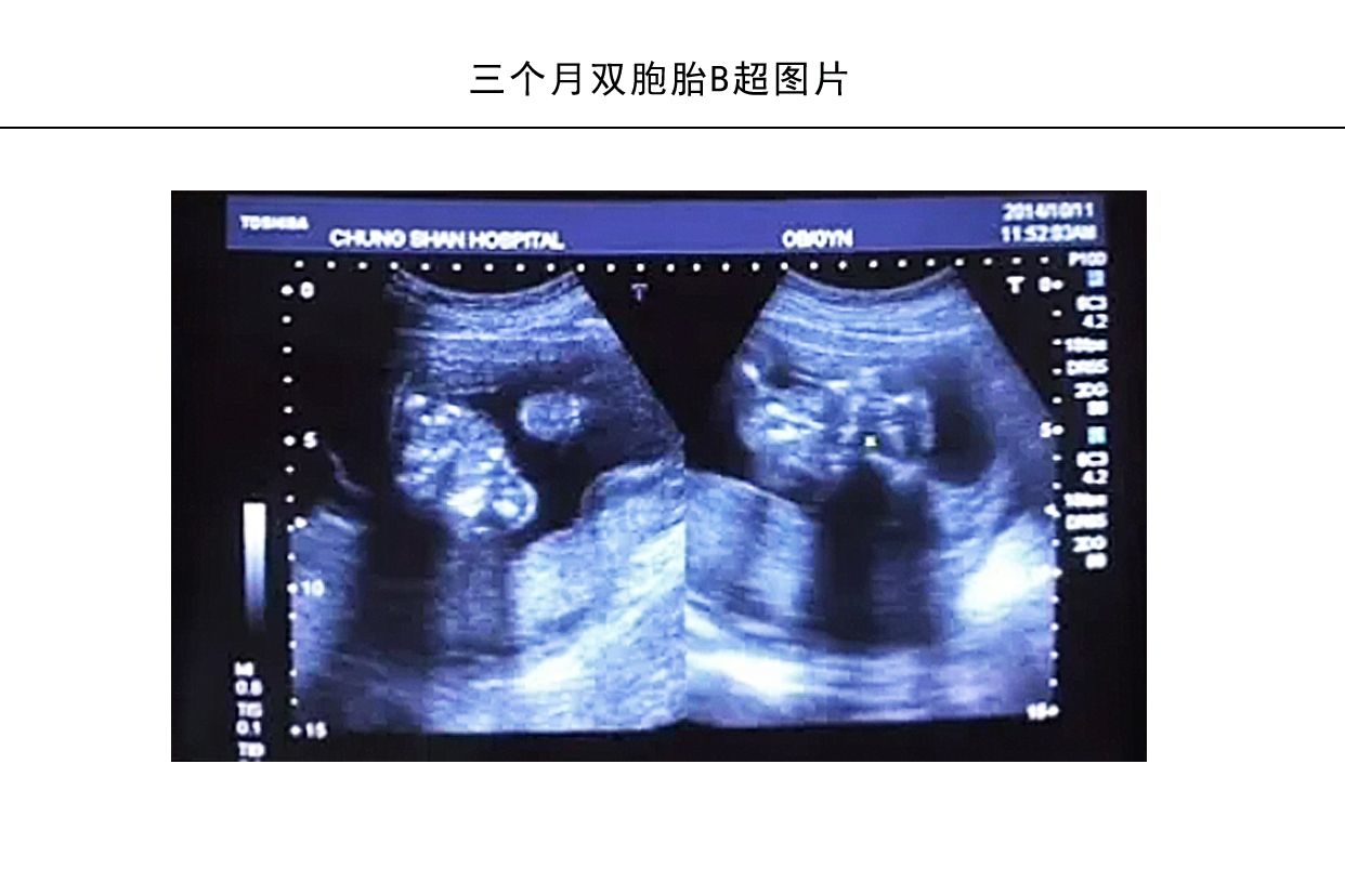 三个月双胞胎b超图片_39健康网 image