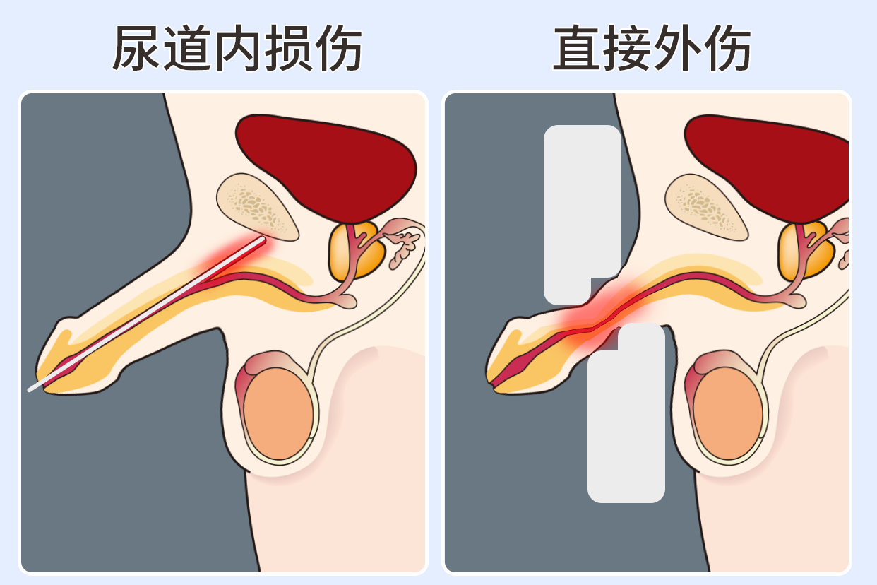 海绵体断裂图片