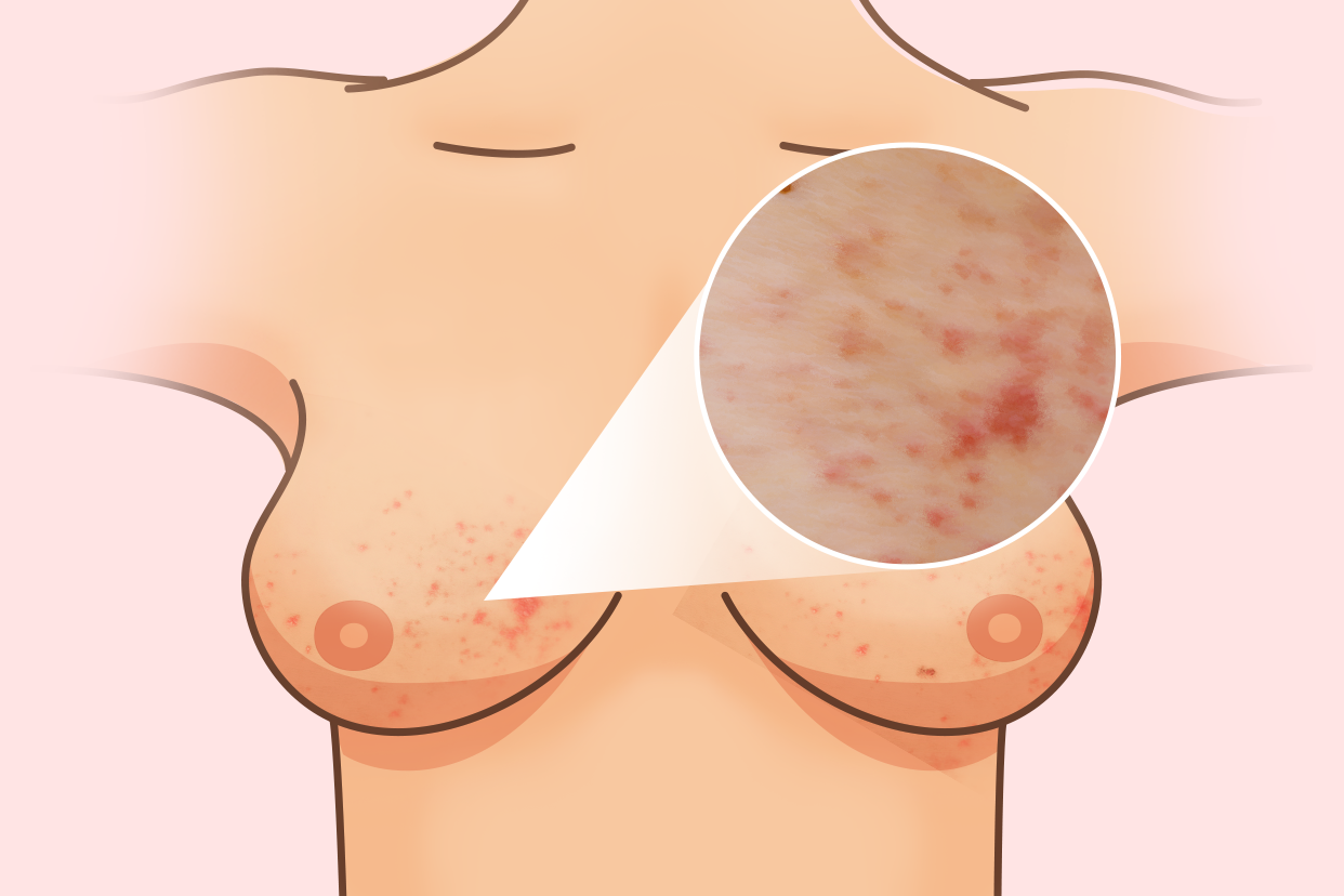 哺乳期乳房长痱子图片