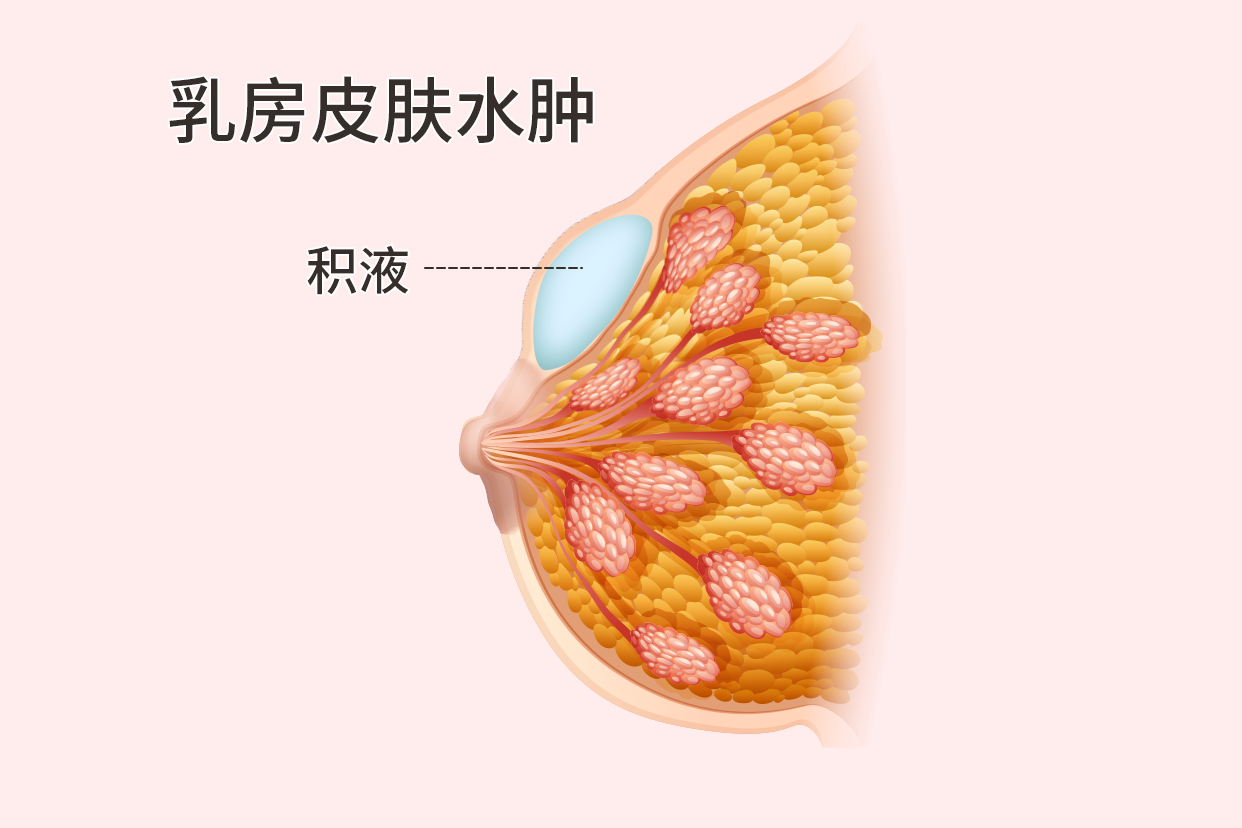 乳房皮膚水腫圖片