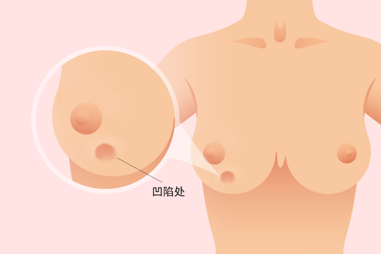 乳腺癌乳房凹陷图片