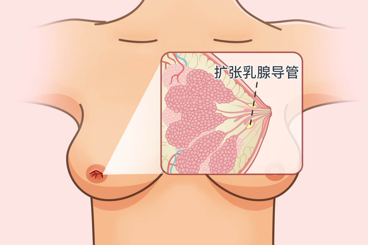 乳腺局部导管扩张乳头凹陷图片