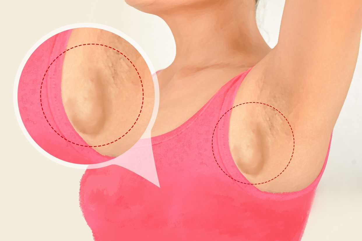 乳腺癌的晚期症状图片图片