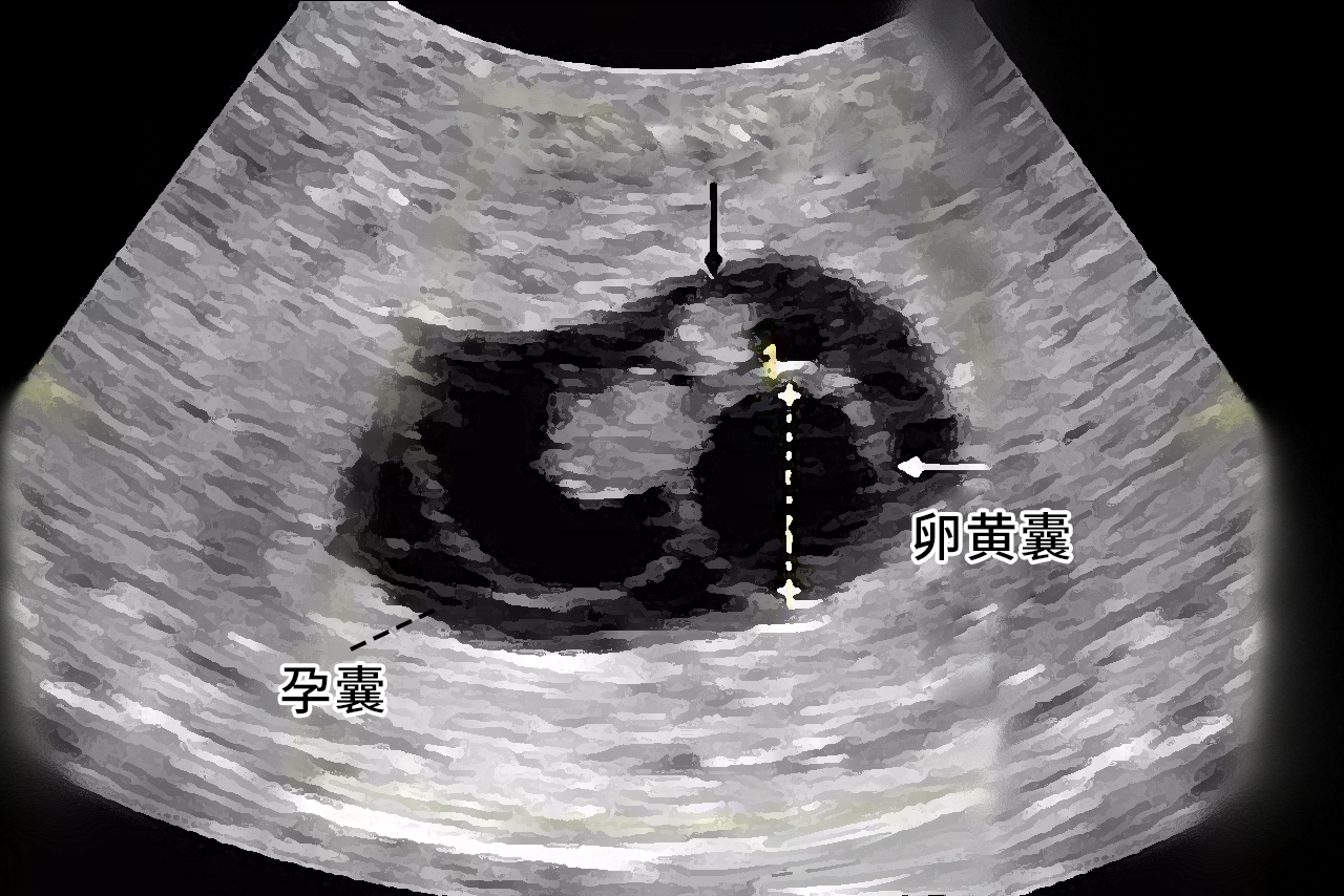 孕囊结构图解析图片