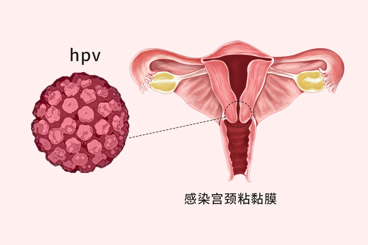 hpv病毒图片初期女性图片