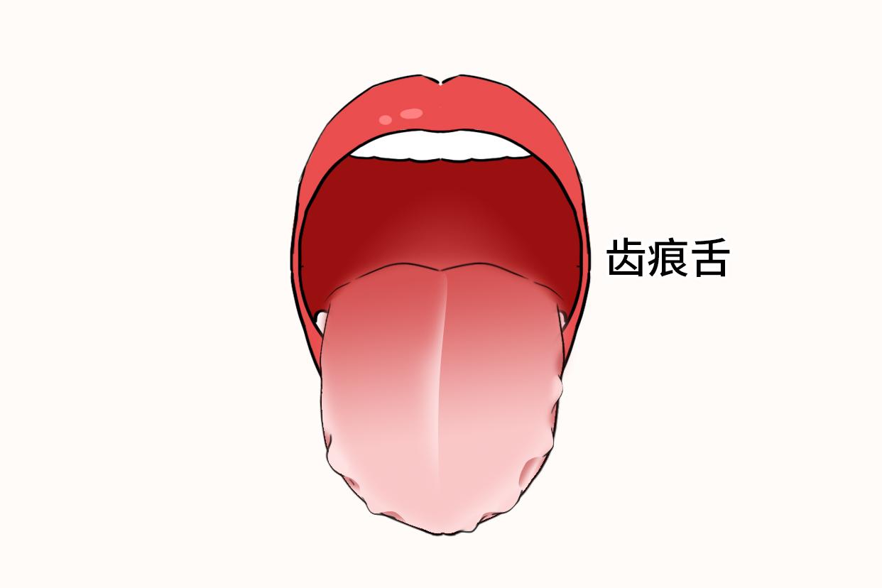 齿痕舌图
