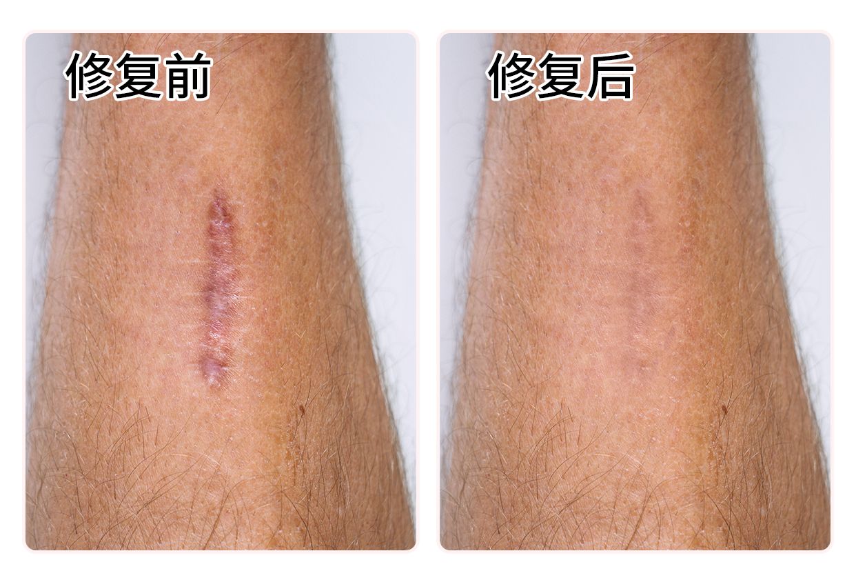 PLASMA治疗疤痕效果图