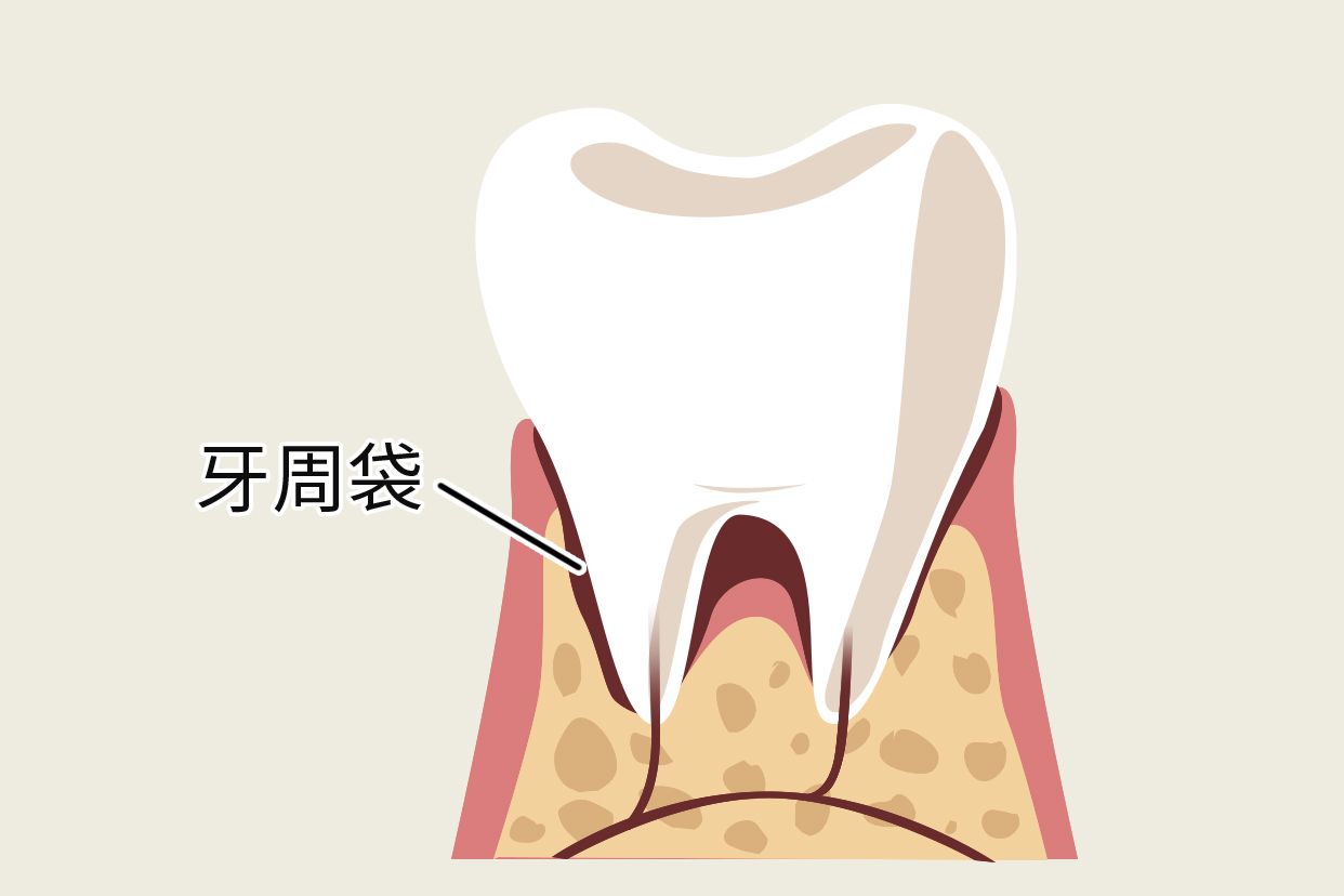 袋状结构,通常是牙周疾病的临床表现之一,可以通过使用药物治疗和手术