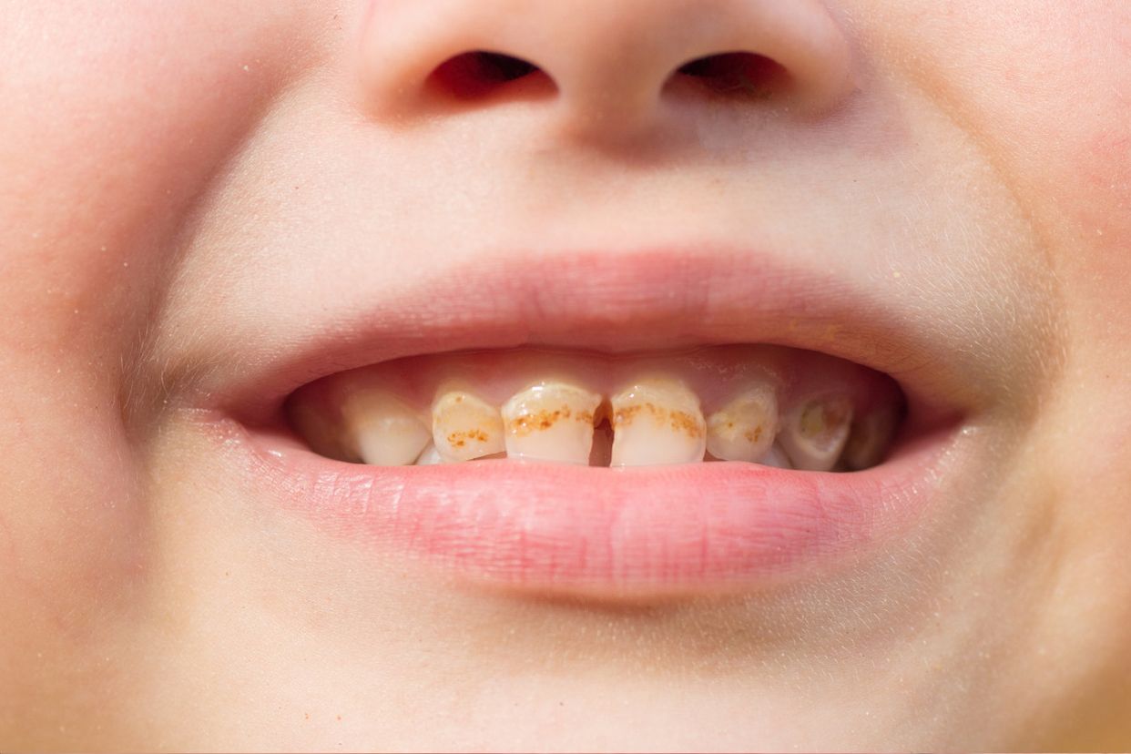 门牙龋齿图片