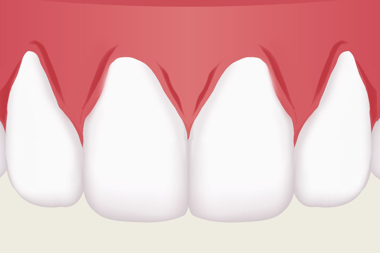 牙龈萎缩图