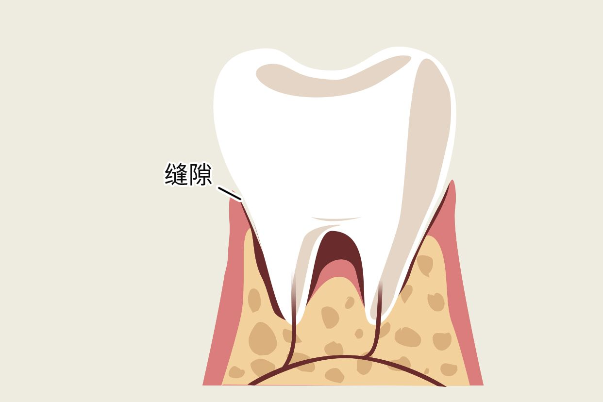 牙冠和牙龈缝隙图