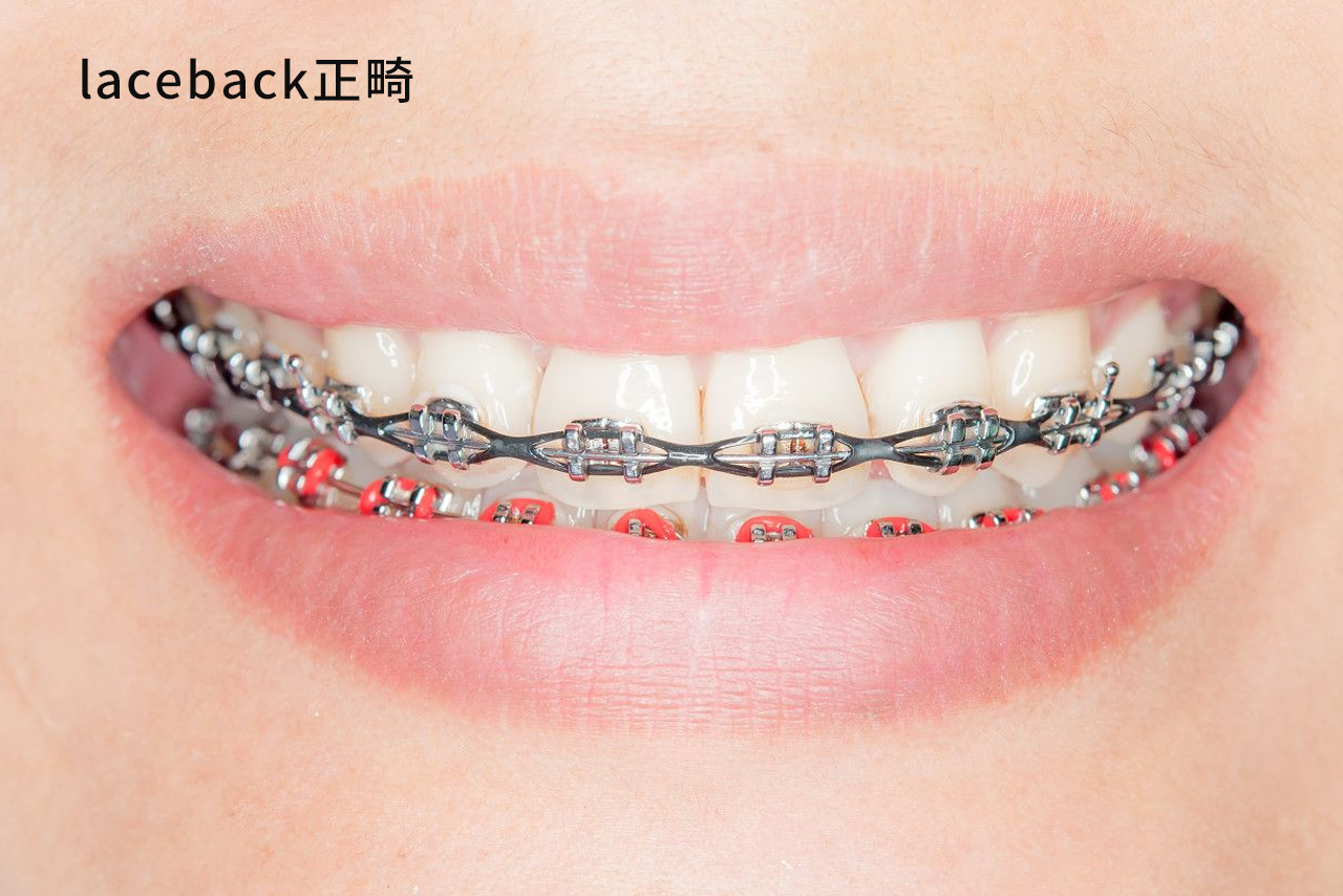 laceback正畸图