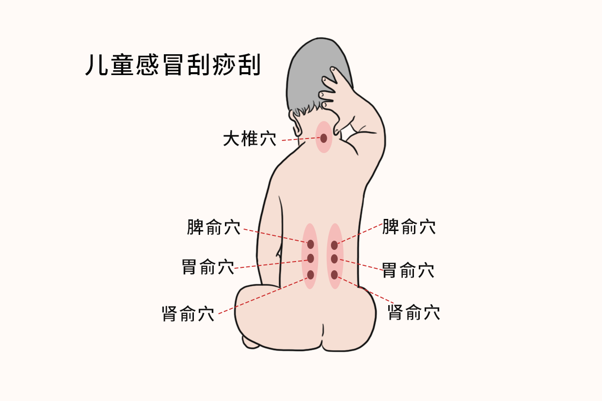 儿童感冒刮痧部位图