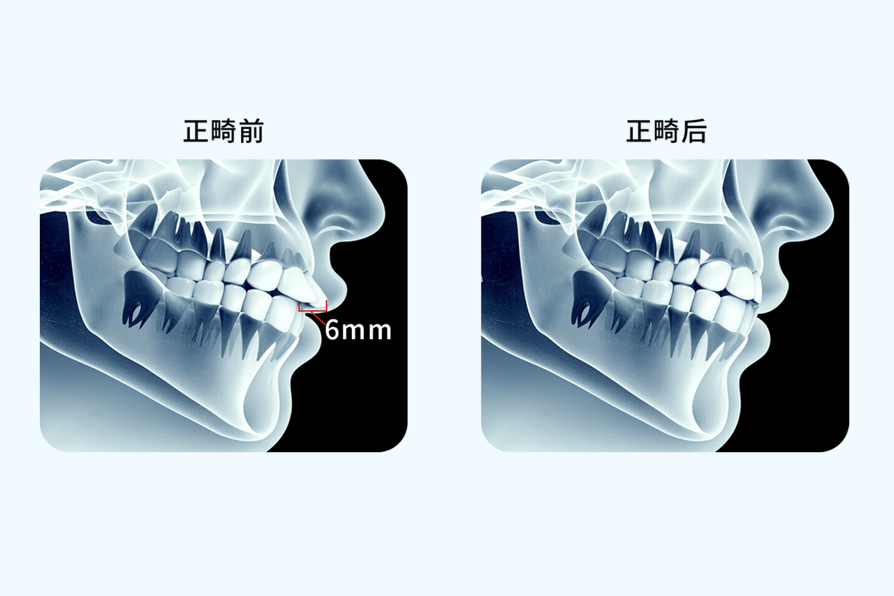 正畸前后对比图