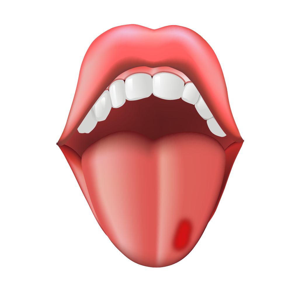 舌苔侧面红斑图