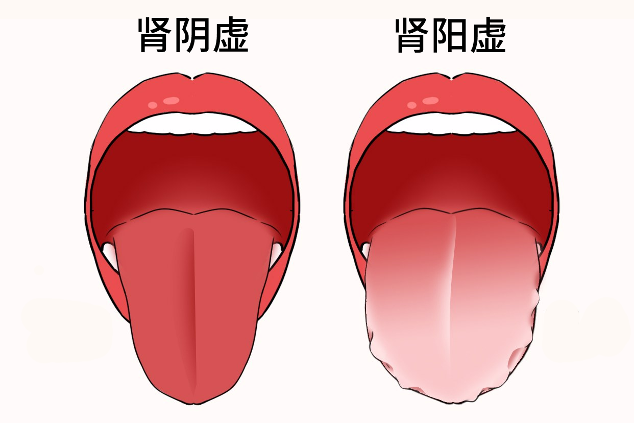女性肾阴虚和肾阳虚舌象图片