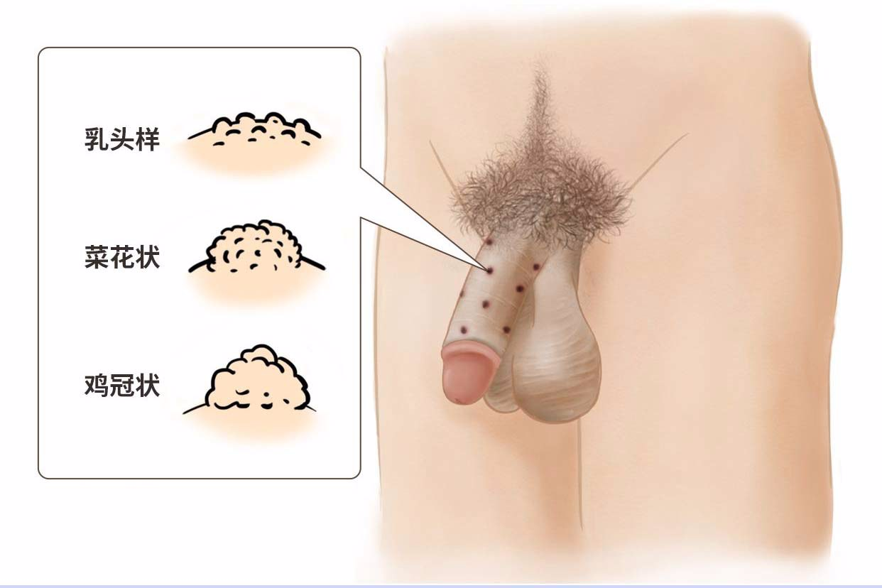 男性感染HPV39型症状图片