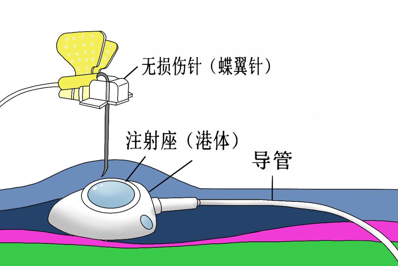 输液港无损伤针图片