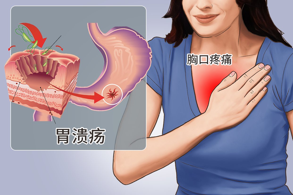 下正中或偏左部位的疼痛,但高位胃溃疡的疼痛可出现在左上腹或胸骨后