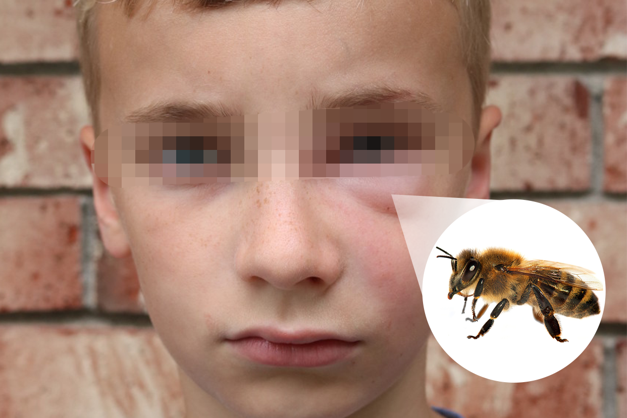 小孩被蜜蜂蛰了搞笑图图片