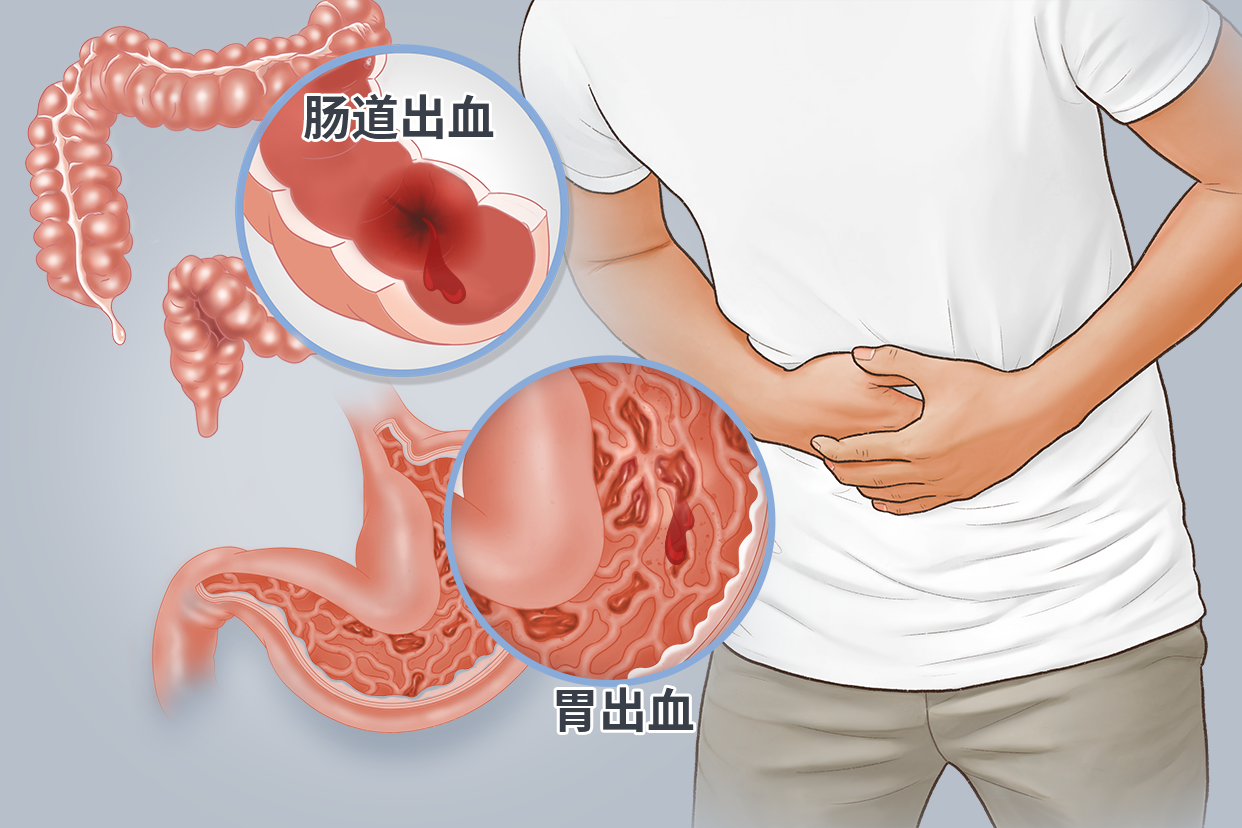肠道出血及胃出血图