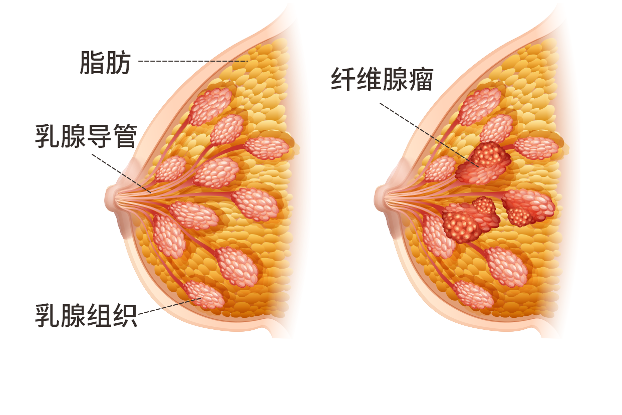 乳腺纤维腺瘤是乳房较常见的良性肿瘤,由乳腺上皮和纤维组织增生而成