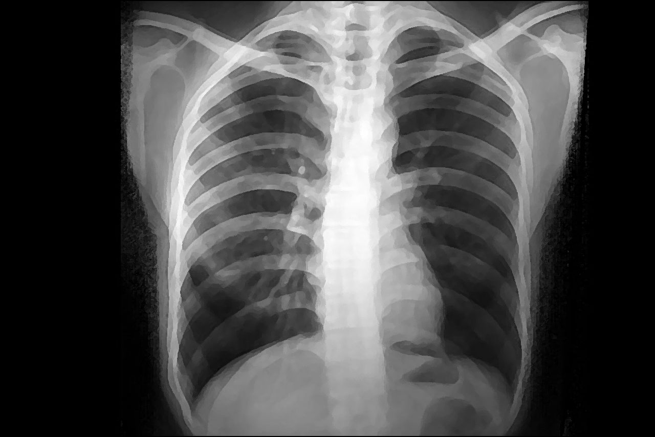 肺CT有透亮影图