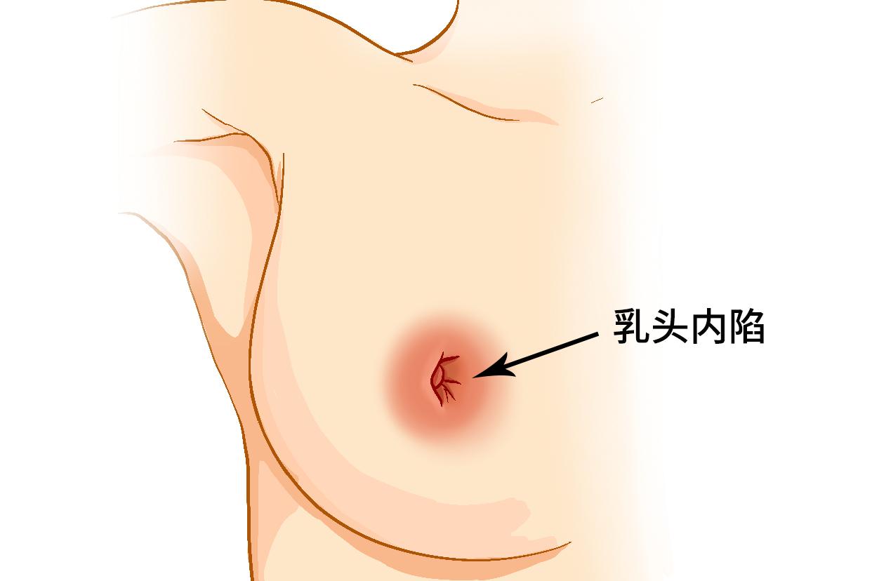 乳房内陷图