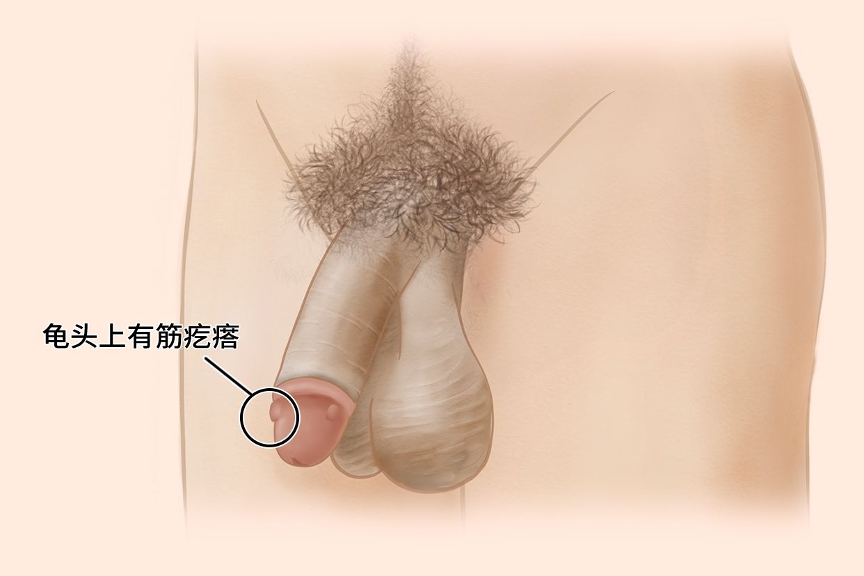 龟头疙瘩图