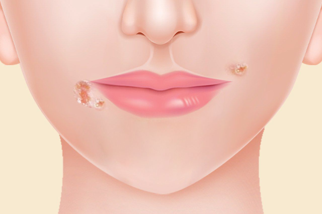 二期梅毒嘴唇图片