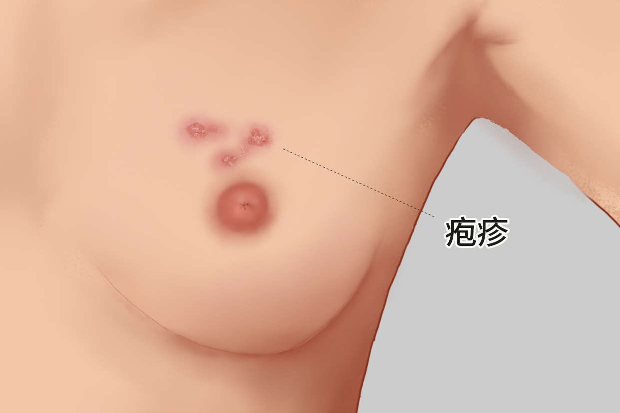 女性乳房疱疹图