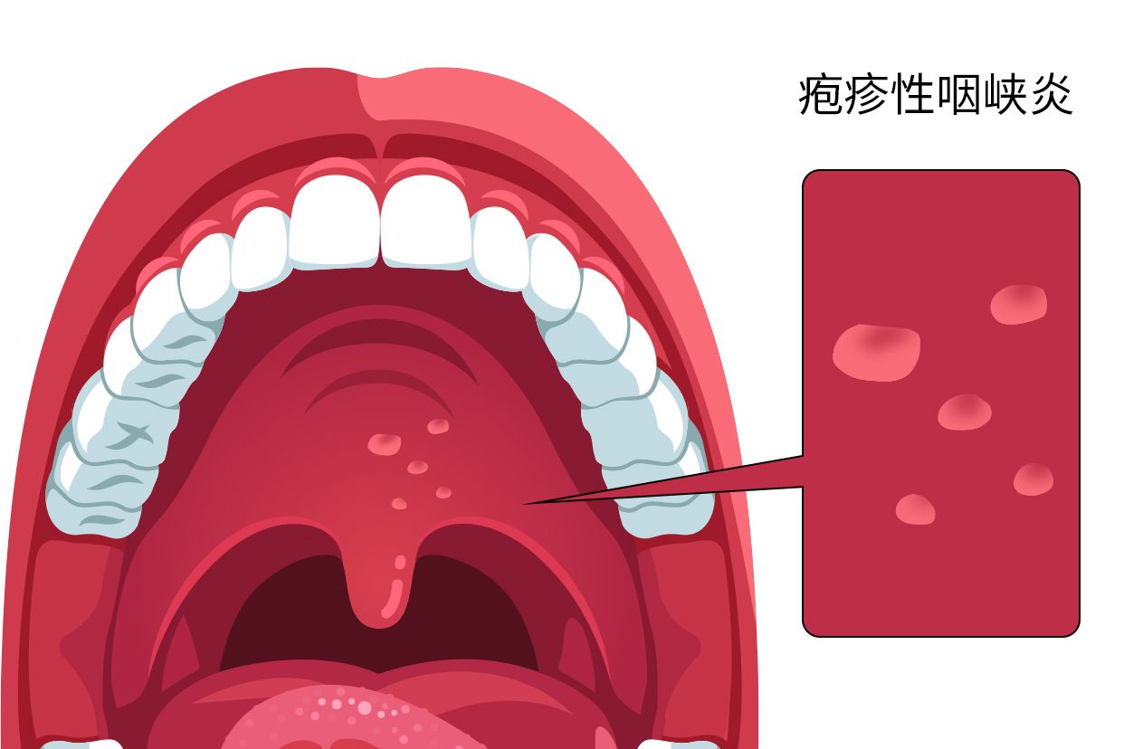 疱疹性咽峡炎