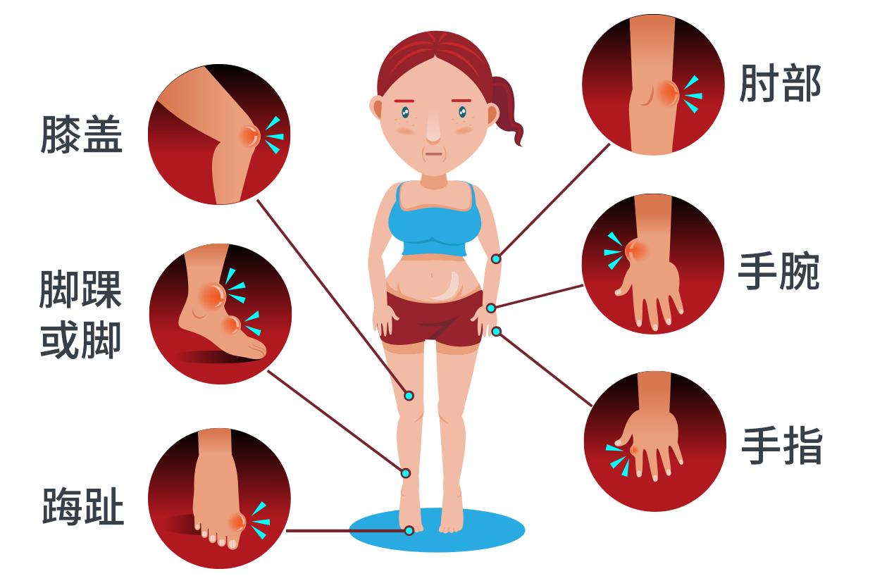 女人痛风的发作部位多见于肘部,膝盖,脚踝等关节部位