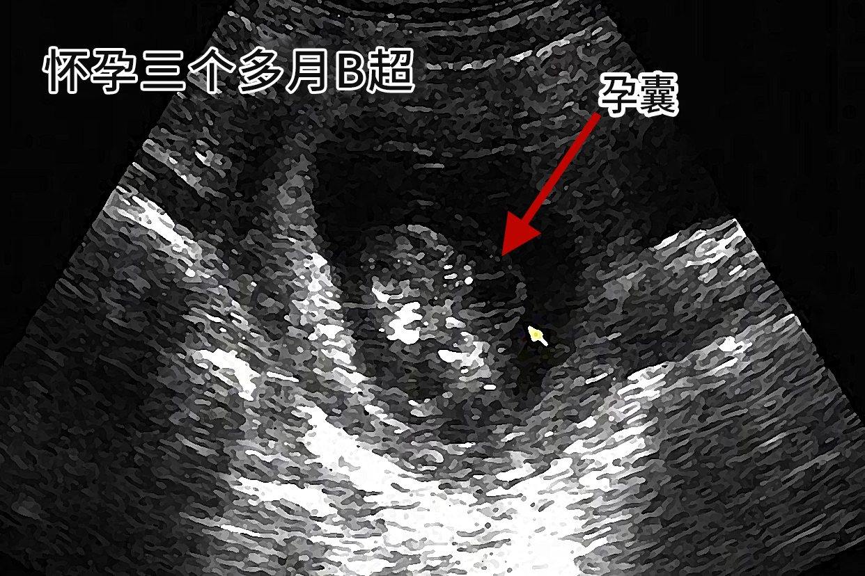 怀孕三个多月B超图