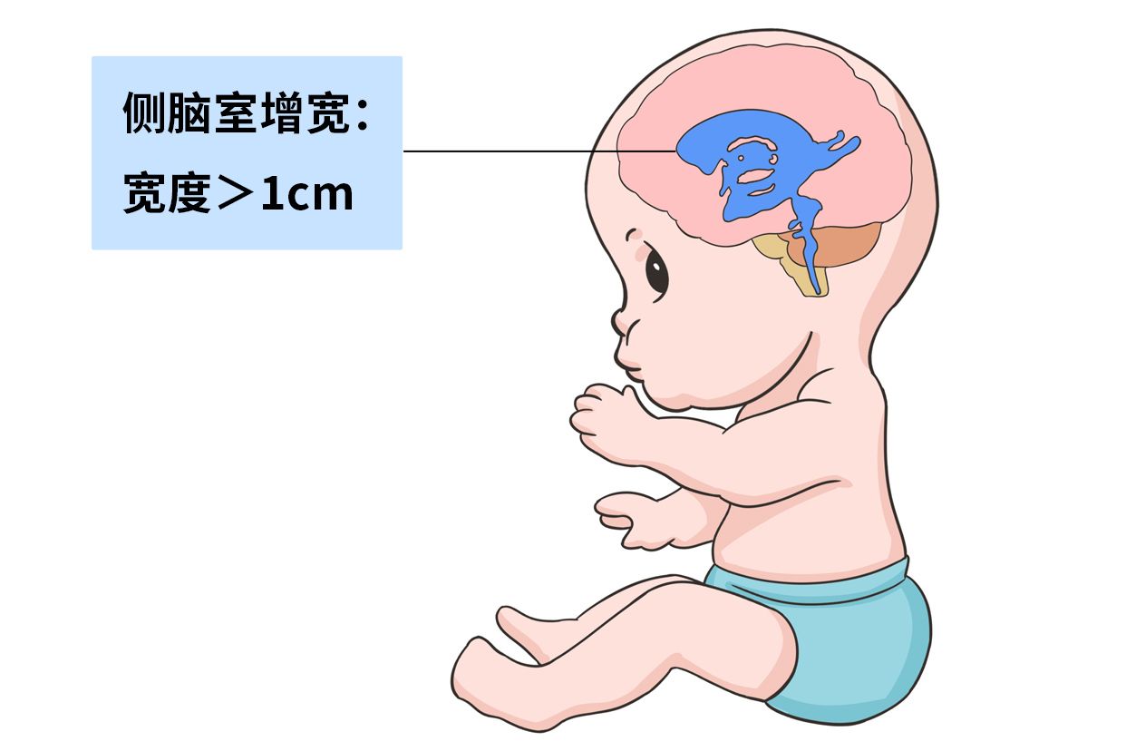 新生儿侧脑室增宽图片图片