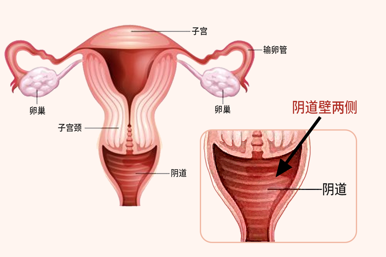阴道 阴道壁两侧长什么样图片_39健康网