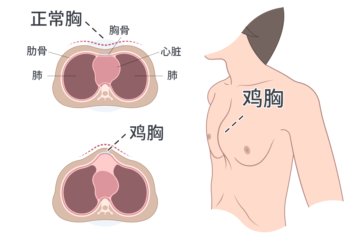 鸡胸图片