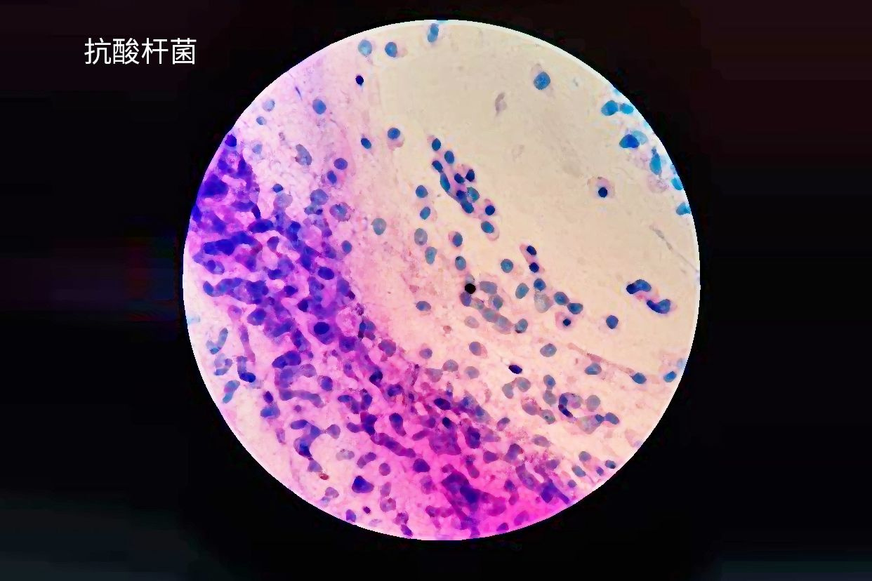 抗酸杆菌图片