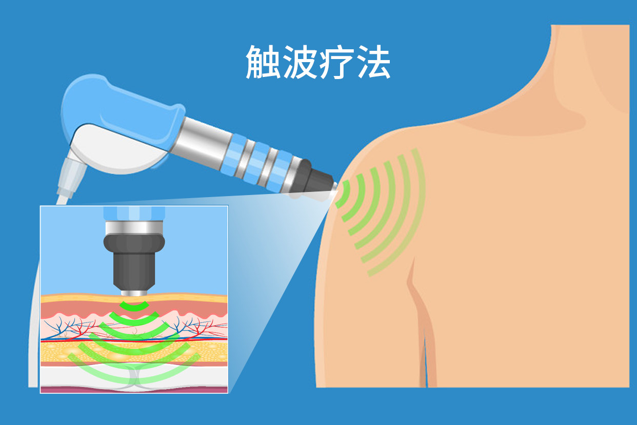 触波疗法图