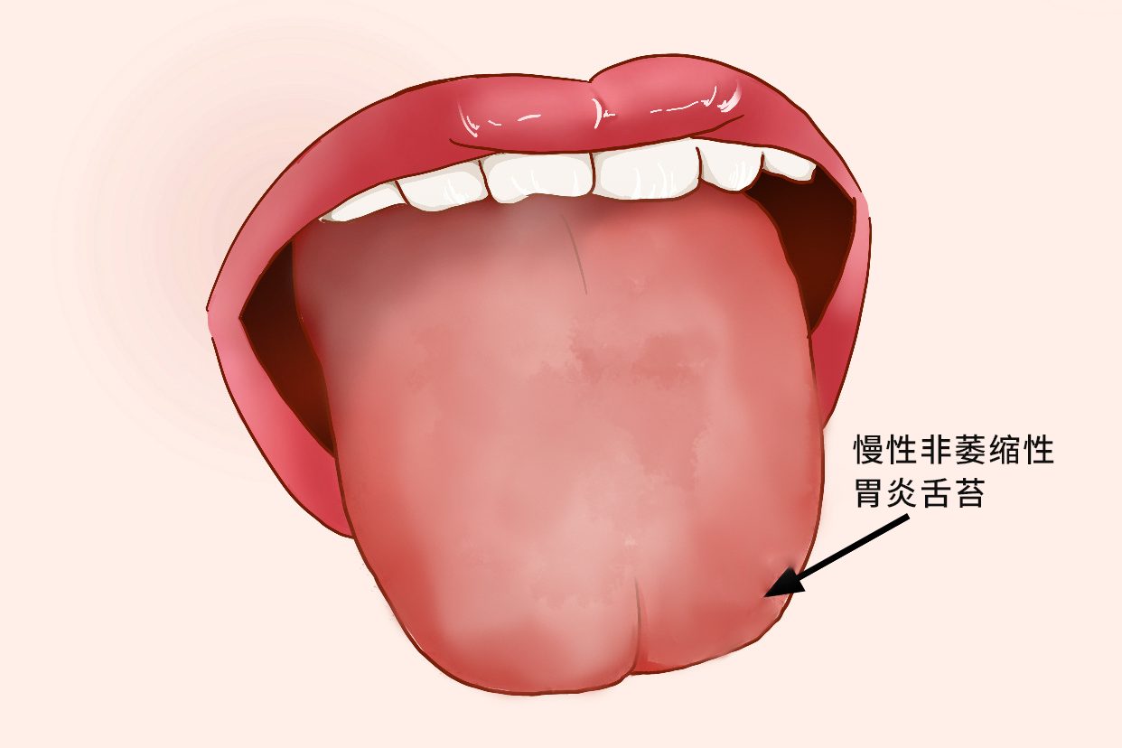 慢性非萎缩性胃炎舌苔图片
