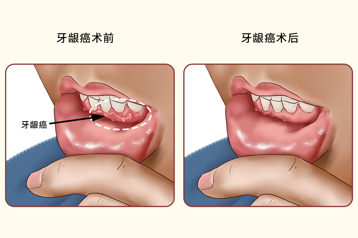 牙龈癌术后图片