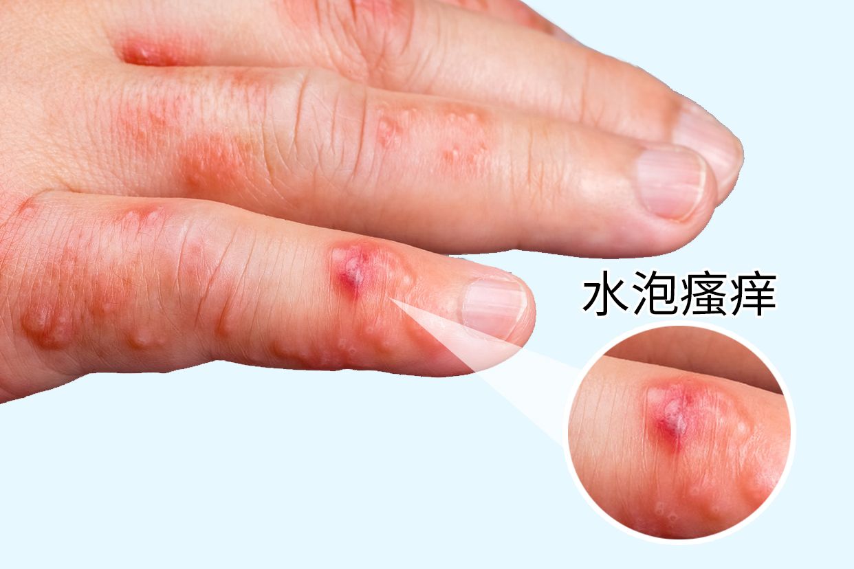 手指边上长期起小水泡很痒可能是汗疱疹,水疱型手癣等导致的