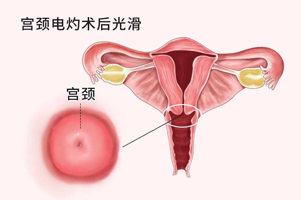 宫颈电灼术后光滑图片