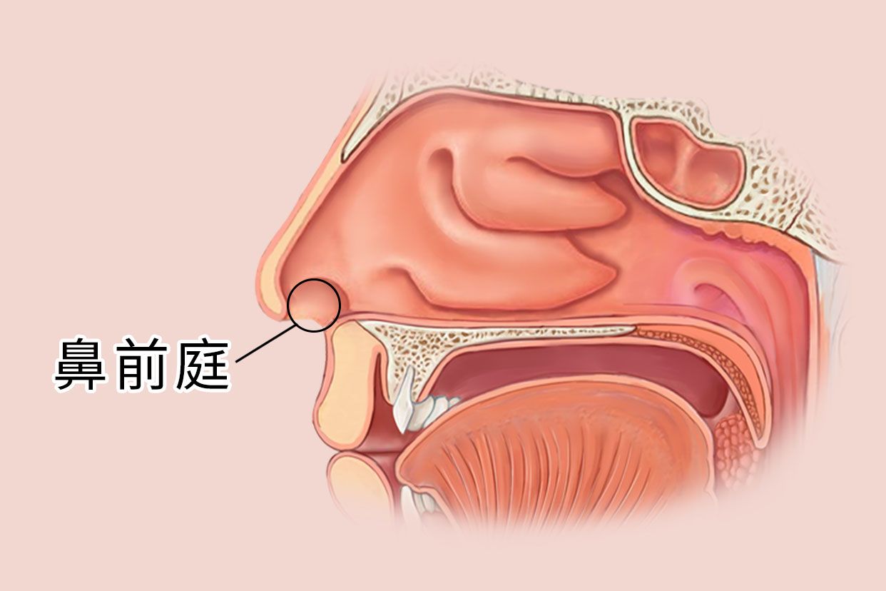 鼻前庭囊肿如何消肿图片