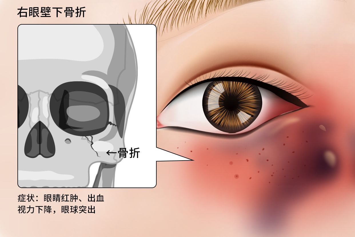 右眼壁下骨折症状图片