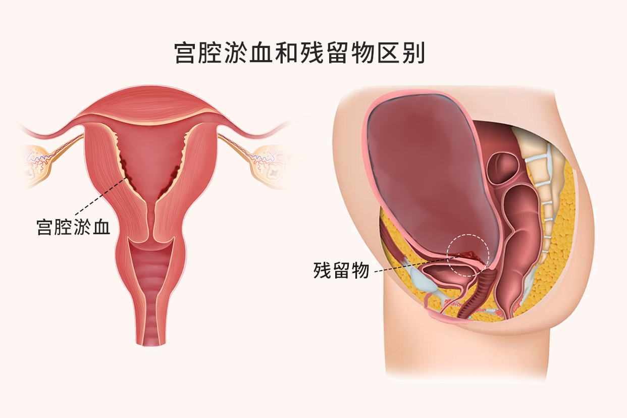 宫腔淤血和残留物区别图