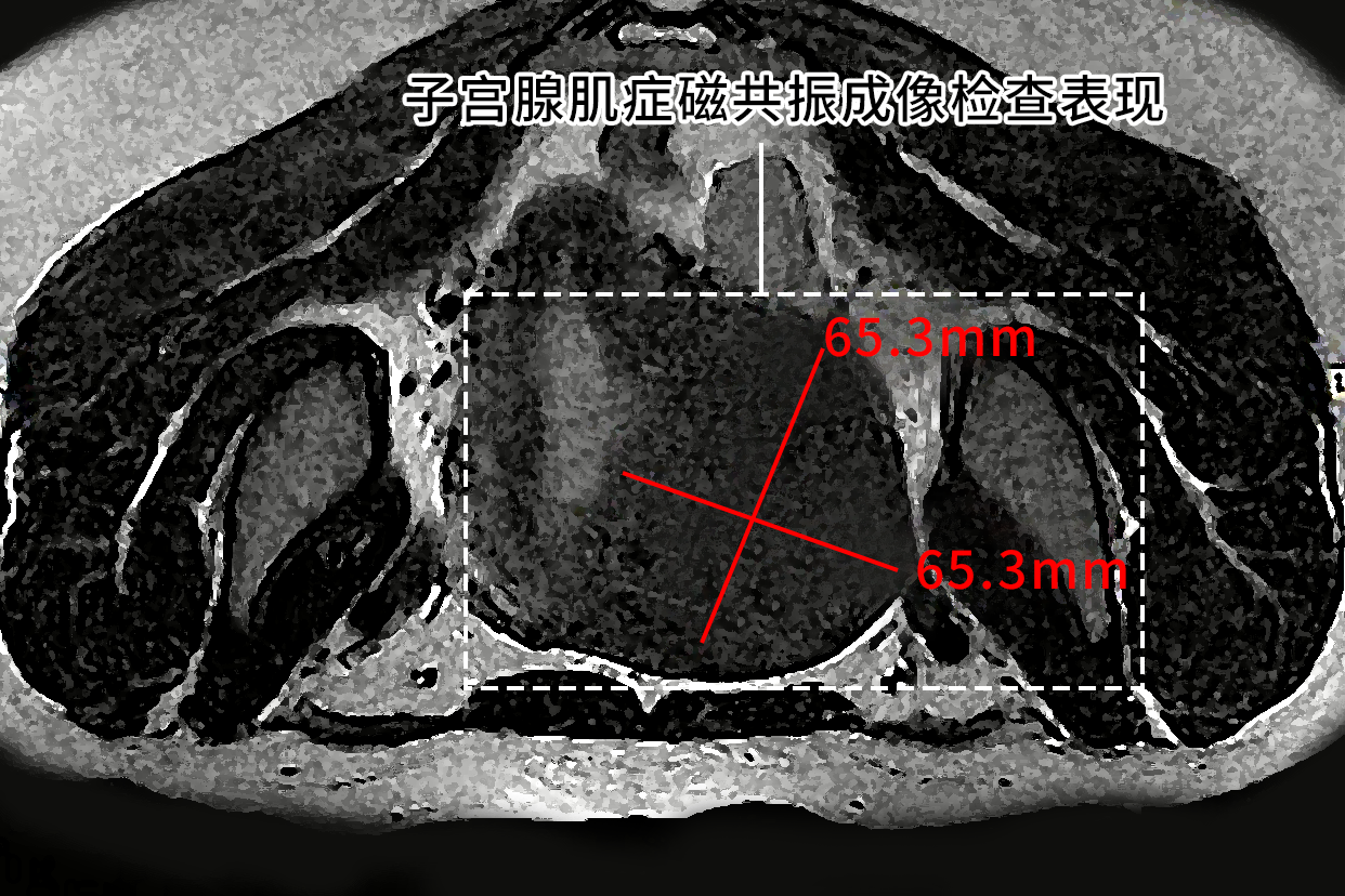 子宫腺肌症磁共振成像检查表现图片