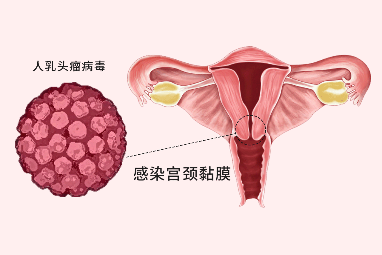 HPV感染位置图片