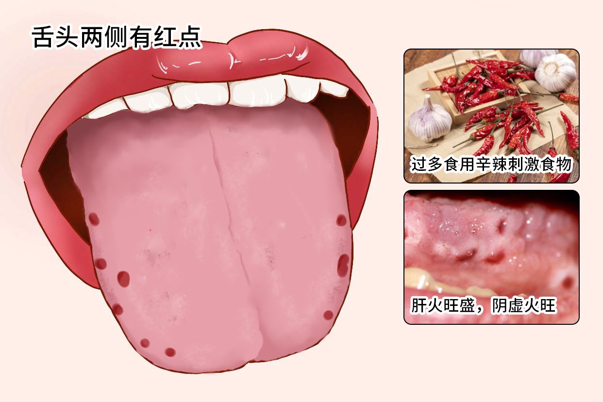 舌头两侧有红点怎么回事图片
