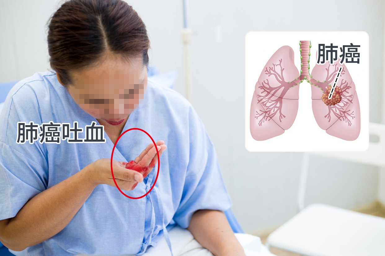 肺癌吐血图片